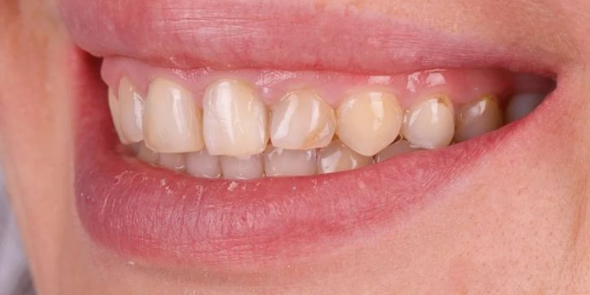 Antes — Carillas dentales