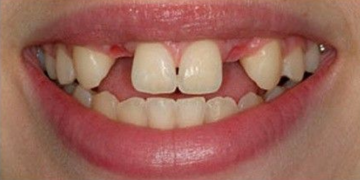 Antes — Implantes dentales
