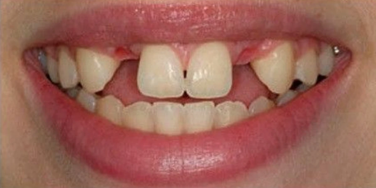 Antes — Implantes dentales