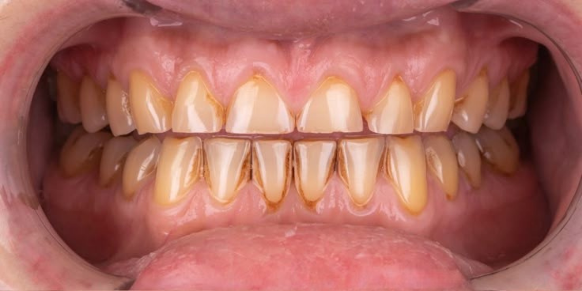 Antes — Rehabilitación oral