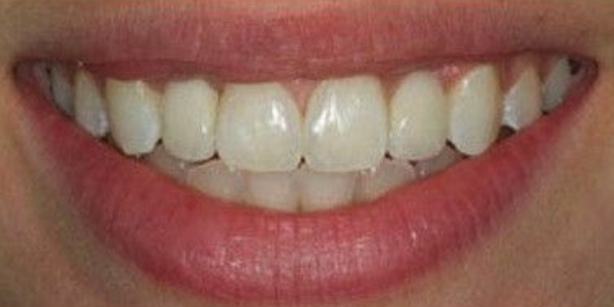 Después — Implantes dentales
