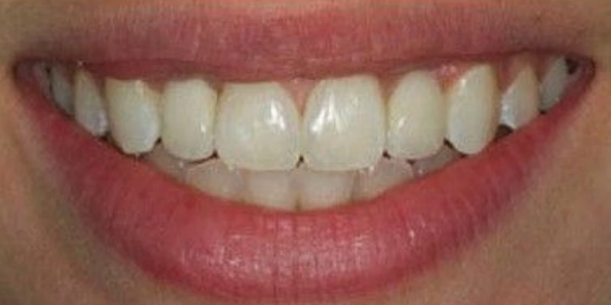Después — Implantes dentales